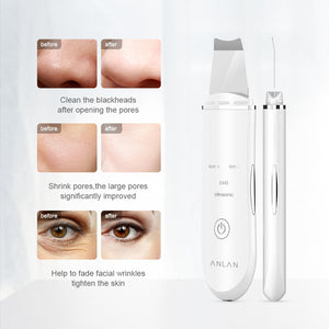 ultrasonic shovel blackhead